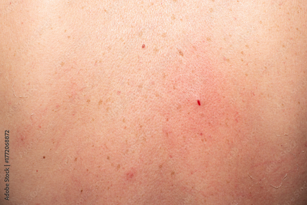 Fototapeta premium Close-up of skin with inflammation, redness and small bleeding wound.