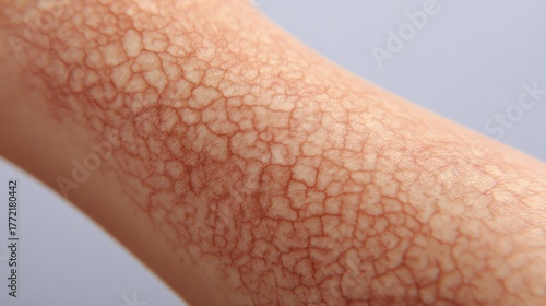 Close-Up of Dry Cracked Skin on Arm