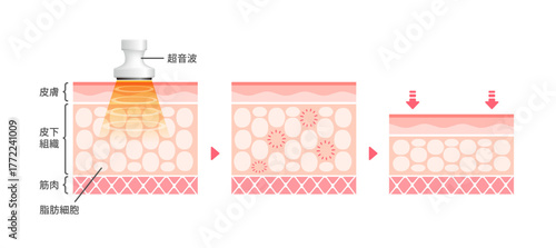 キャビテーションの仕組みと効果　皮膚断面図イラスト / 美容・ダイエット