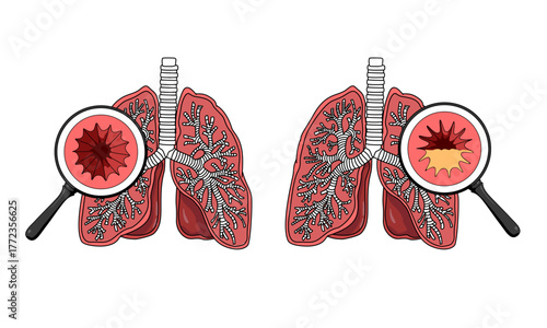 Illustration of thick mucus in the lungs, bronchitis, asthma attack, shortness of breath. Inflammation of the bronchial tubes. Vector illustration for medical, health, and clinics.