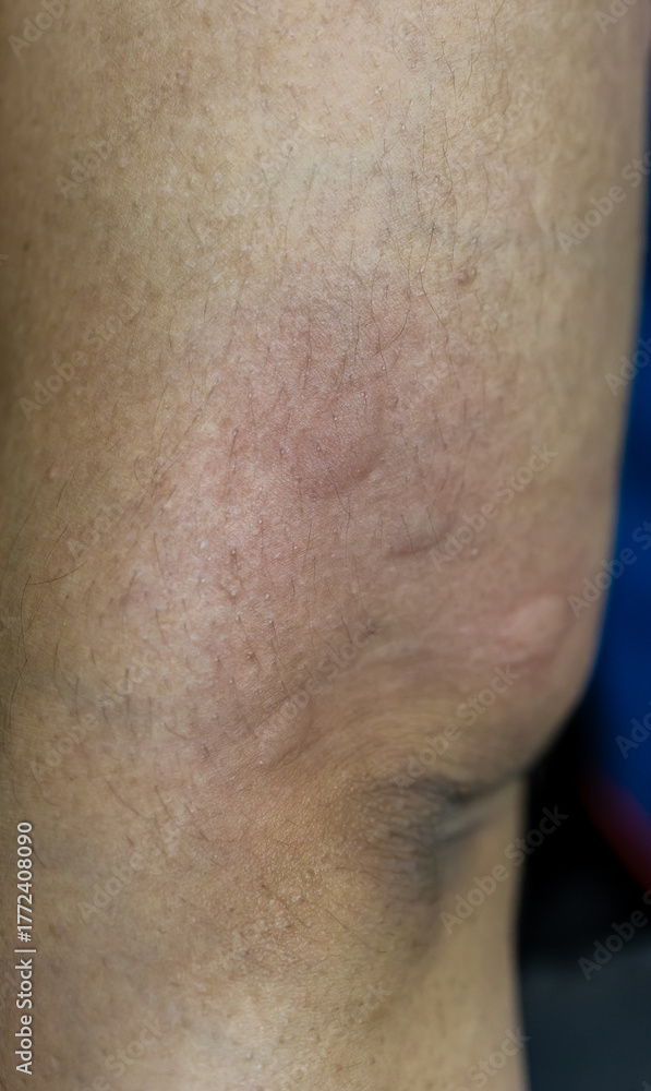 Fototapeta premium skin allergy showing severe irritation and redness from bug bite or insect sting