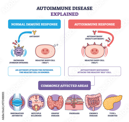 Autoimmune disease brief diagram contrasts normal and autoimmune response, highlighting antibody, autoantibody, and healthy cell, icons show affected organs. Outline diagram