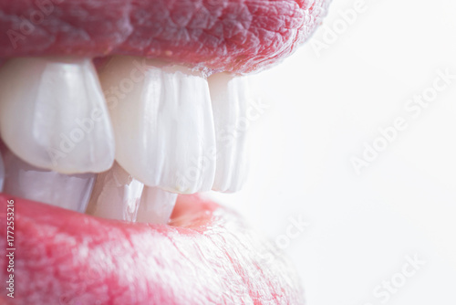 Photos ceramic crowns and veneers