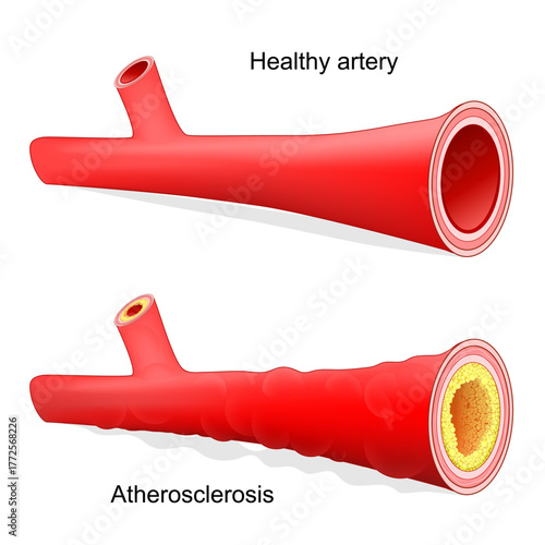 Atherosclerosis. Healthy artery with normal blood flow and blood vessel with Arteriosclerotic vascular disease that have accumulated cholesterol in wall, and abnormal blood flow. 