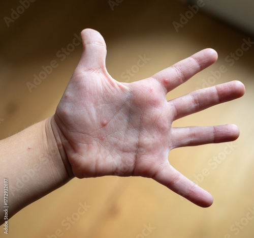 Child hand showing symptoms hand foot mouth disease