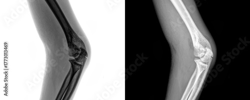 X-Ray of Elbow Lateral View Demonstrating Bone Anatomy and Joint Alignment for Fracture Detection Isolated on Transparent or White Background for Orthopedic and Anatomy Purpose