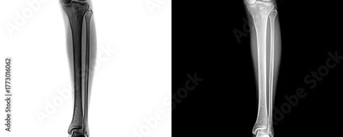 Leg Anterior View X-Ray Showing Tibia and Fibula Bone Alignment for Detecting Fractures and Pre-Surgical Planning Isolated on a Transparent Background.