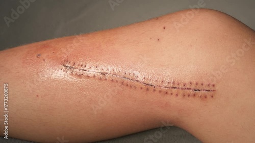 Leg with large postoperative scar