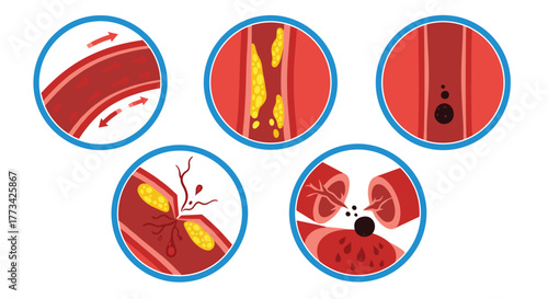 Illustration depicting stages of blood vessel blockage: normal blood flow, cholesterol buildup, clotting, rupture, and complete blockage.