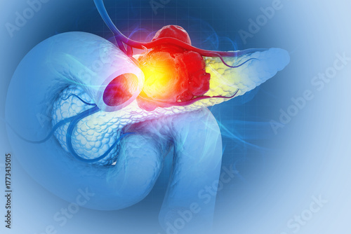 Pancreatic cancer is cancer that forms in the cells of the pancreas. 3d illustration © Crystal light