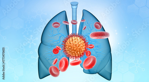 Human lungs virus bacterial infection. 3d illustration