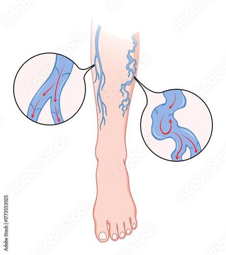 Varicose veins. Blue blood vessel visible through the skin, abnormally swollen leg. Vascular disease diagnostic and treatment. Venous insufficiency medical disease