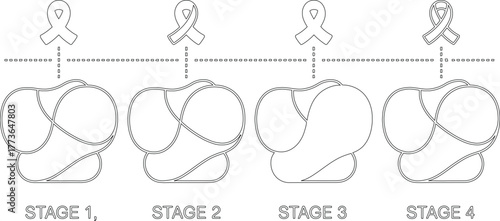 Black and White Outline of Cancer Stages with Ribbons Above Each Stage Shown