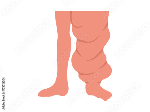 Leg a Person Elephantiasis Disease Illustration
