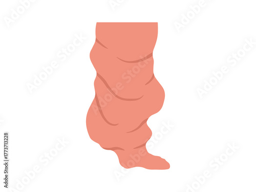 Elephantiasis Disease Illustration
