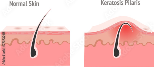 Keratosis pilaris. Hair structure, anatomy. Hair grows back into the skin instead of rising to the surface. Skin part diagram. Vector  illustration