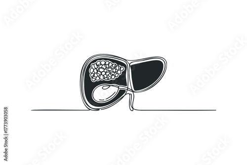 Human Liver Diagram with Gallbladder and Stones