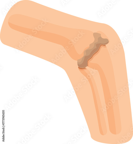Knee joint with damaged bone and cartilage representing arthritis, osteoporosis, or other joint disease