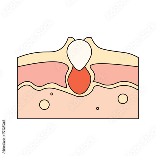 Acne Skin Cross Section