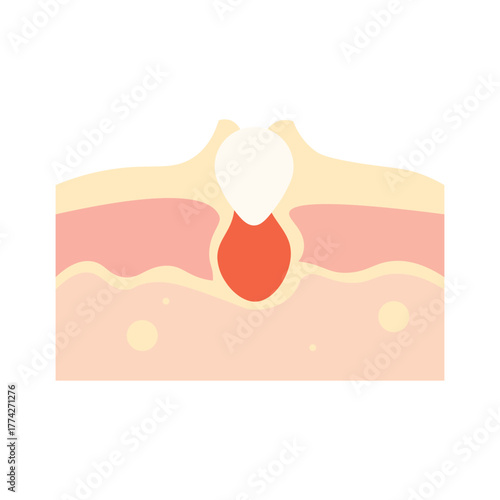 Acne Skin Cross Section