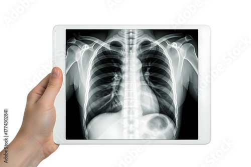 Hand holding tablet with chest xray isolated on transparent background