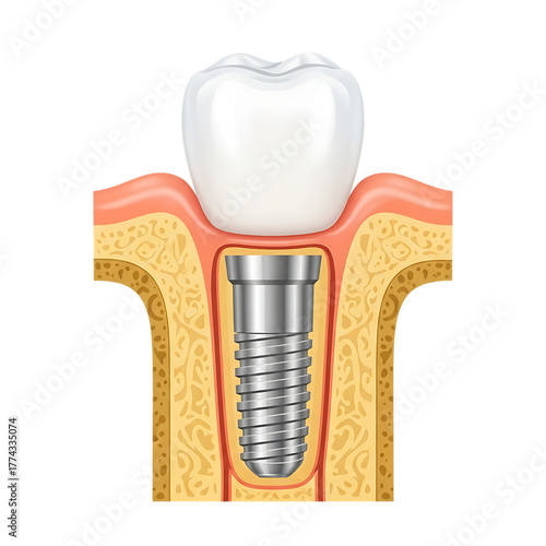 Dental implant cross section showing screw in jaw bone with tooth isolated on transparent background