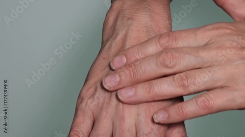 A close-up of a 58-year-old woman's hands, showing prominent veins. The subcutaneous fat layer is absent, the skin is thin, and the veins are visible through it. Cosmetology and plastic surgery.