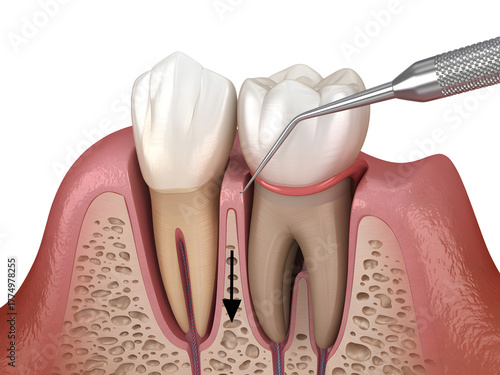 Periodontal probing shows gum recession isolated on transparent background