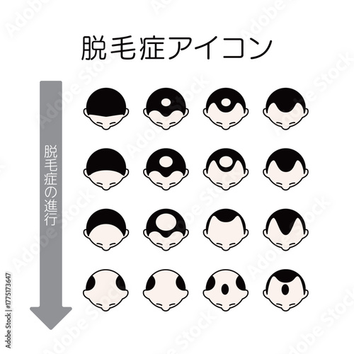 脱毛症アイコンセット　頭頂部ハゲ・M字ハゲの進行段階を示す図