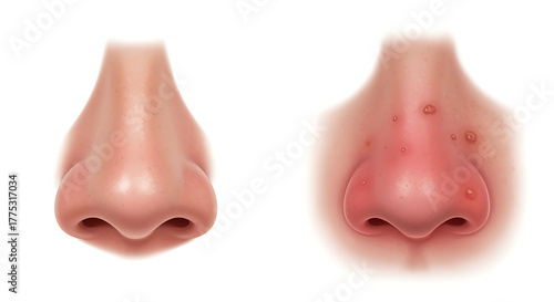 Comparison of a healthy nose and a affected by rosacea skin medi