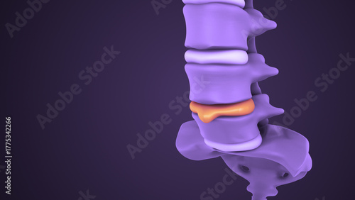 Medical Video of Spinal Disc Herniation Process
