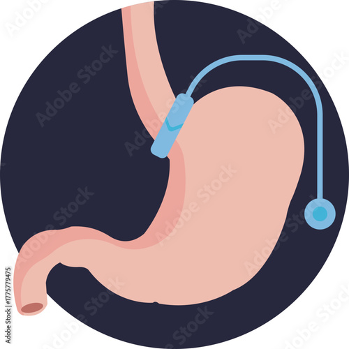 Adjustable band placed around the stomach to limit food intake and aid weight loss.