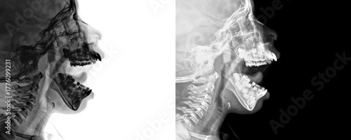 Nasopharynx in Lateral View Depicting Airway Obstruction and Enlarged Adenoids for Chronic Adenoiditis Assessment Isolated on Transparent Background