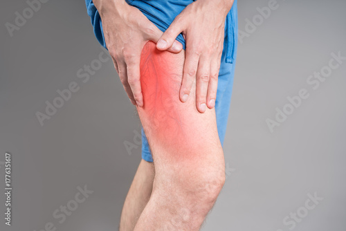 Obraz na plátně Varicose veins on male leg - medical photo of visible swollen veins, vascular di