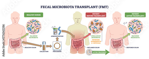 Fecal microbiota transplant (FMT) shown from donor to patient, stool processing and administration restore gut microbiota, key objects, intestines, capsules, bacteria. Outline diagram