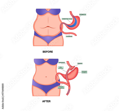 Gastric Bypass Surgery Concept with Roux-en-Y Procedure and Stomach Diagram