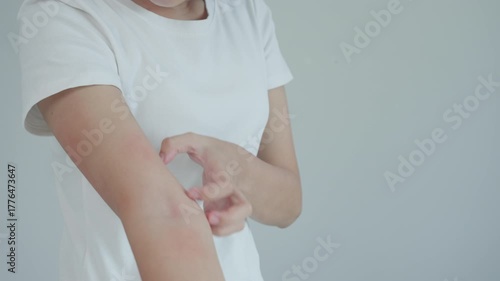 skin problem and beauty. Young woman scratch body has itchy skin from skin allergic, steroid allergy, sensitive skin, red from sunburn, chemical allergy, rash, insect bites, Seborrheic Dermatitis.