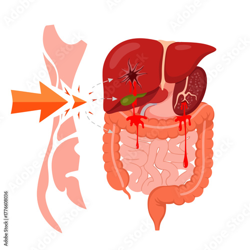Medical illustration depicting internal injury impacting liver and digestive system with external force indicated by arrow