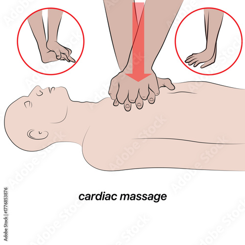 Cardiac massage (CPR) chest compressions.