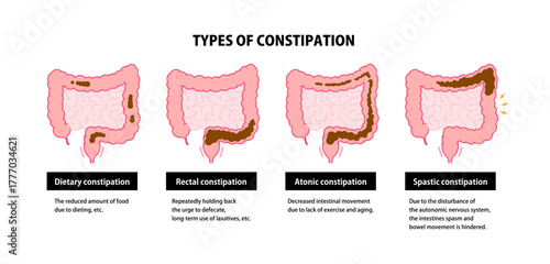 Vector illustration set of types of constipation (with explanation of causes)