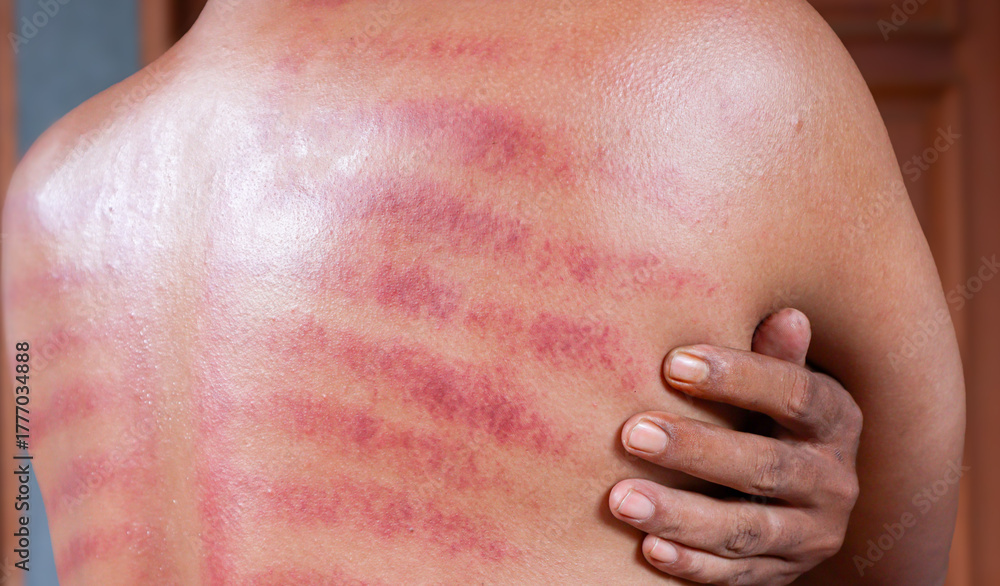 Fototapeta premium Red marks from scraped coin on a man's back. Javanese traditional alternative non-medical treatment to treat symptoms of colds called Kerokan.