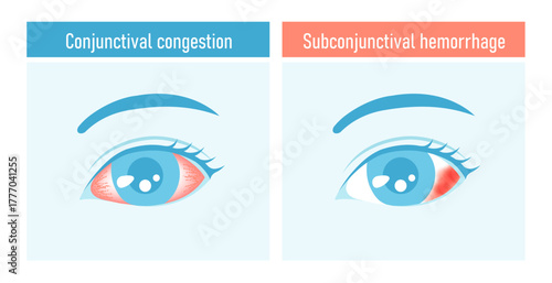 Eye vector illustration set (subconjunctival hemorrhage and conjunctival congestion)