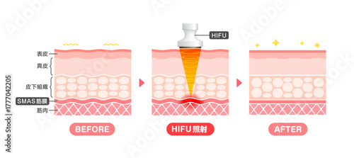Vector illustration of HIFU mechanism and effect.