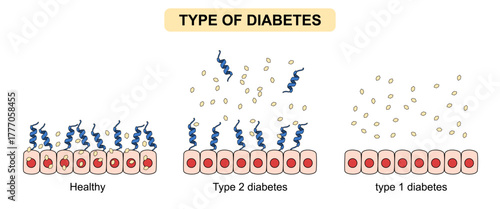 types of diabetes. Insulin response in the body, decreased insulin, resistant cells, increased blood glucose. Vector illustration for medical, biochemistry, science, posters or education