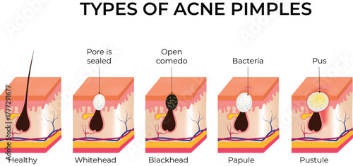 Types of Acne Pimples Explained A Visual Guide to Skin Conditions