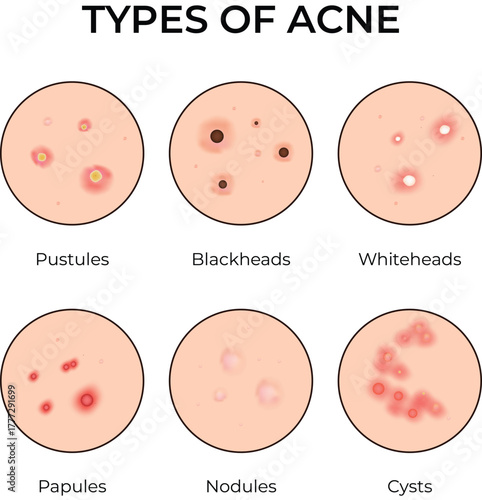 Types of Acne A Visual Guide to Skin Lesion