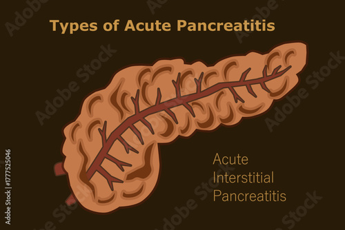 Acute Interstitial Pancreatitis, Types of Acute Pancreatitis