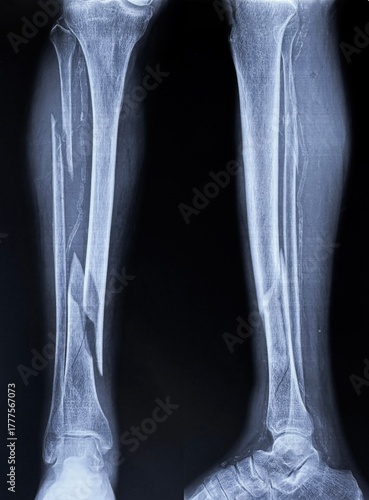 AP and lateral X-rays of lower leg showing comminuted tibial shaft fracture with associated fibular fracture