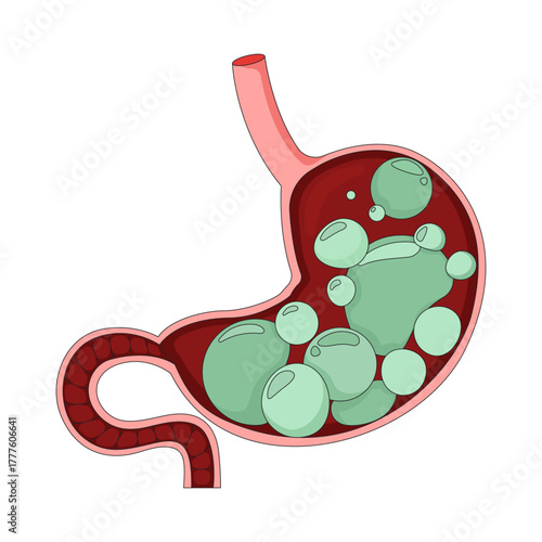 Gassy and bloated stomach with gas bubbles 2D vector illustration. Digestive health. Indigestion symptom. Human organ in cross-section flat object isolated on white background. Colorful cartoon image