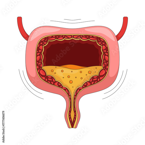 Overactive human bladder with urgency symptom 2D vector illustration. Urinary incontinence, spasms. Trembling walls and urine buildup flat object isolated on white background. Colorful cartoon image